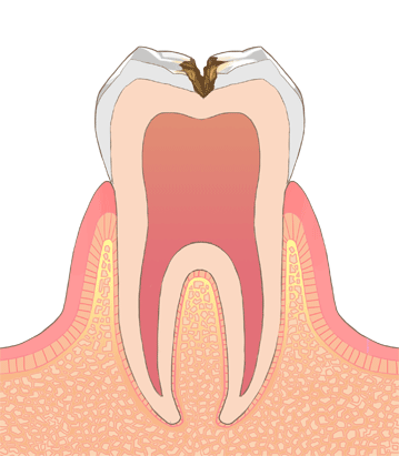 たんじフレンド歯科 C2（象牙質の虫歯）