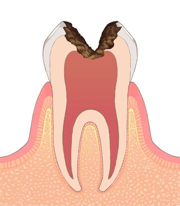 たんじフレンド歯科 C3（神経まで進行した虫歯）