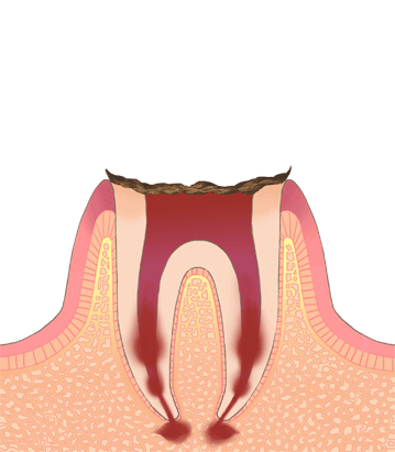 たんじフレンド歯科 C4（歯の根まで進行した虫歯）
